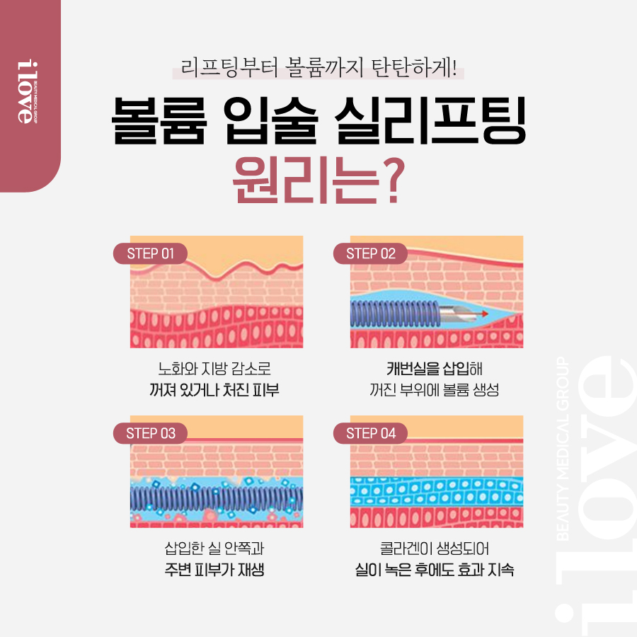 강남역피부과 아이러브강남의원 입술실리프팅 효과
